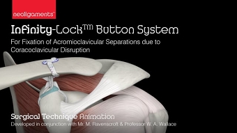 Infinity-Lock Button System