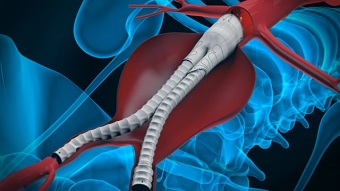 Anaconda Stent Graft system