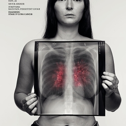 Lung Cancer, See Through The Symptoms