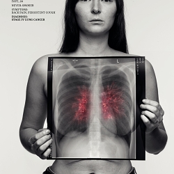 Lung Cancer, See Through The Symptoms